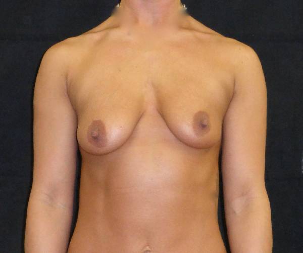 before breast augmentation with lift front view female patient case 3826