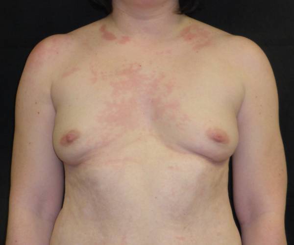 before breast augmentation with lift front view female patient case 3831