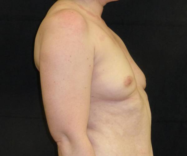 before breast augmentation with lift right view female patient case 3831