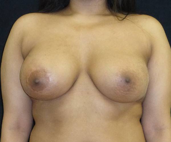 after breast augmentation with lift front view female patient case 3851