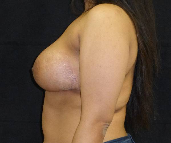 after breast augmentation with lift left view female patient case 3851