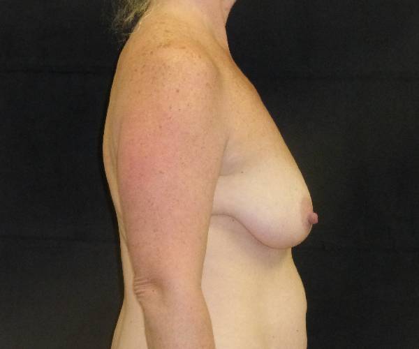 before breast augmentation with lift right view female patient case 3856