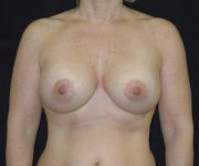 after breast augmentation with lift front view female patient case 3861