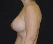 after breast augmentation with lift left view female patient case 3861