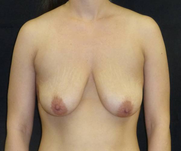 before breast augmentation with lift front view female patient case 3971