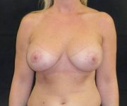 after breast augmentation with lift front view female patient case 3976