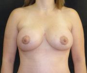 after breast augmentation with lift front view female patient case 3881