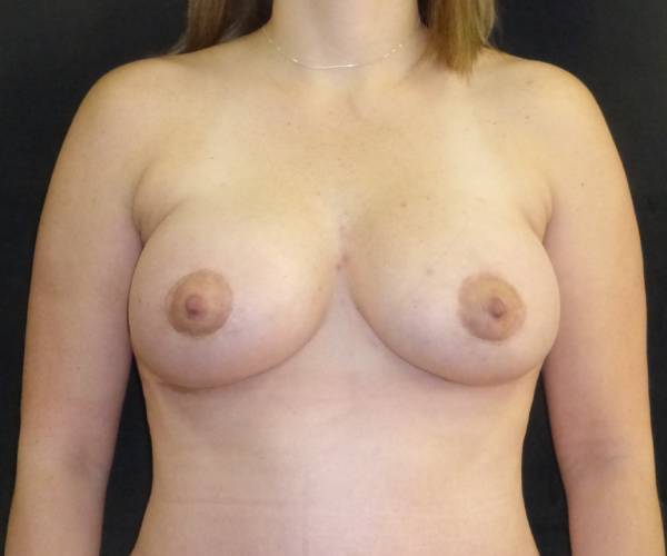after breast augmentation with lift front view female patient case 3881