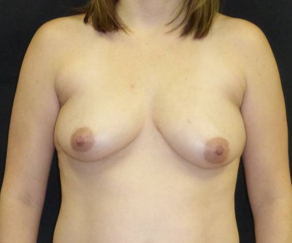 before breast augmentation with lift front view female patient case 3881