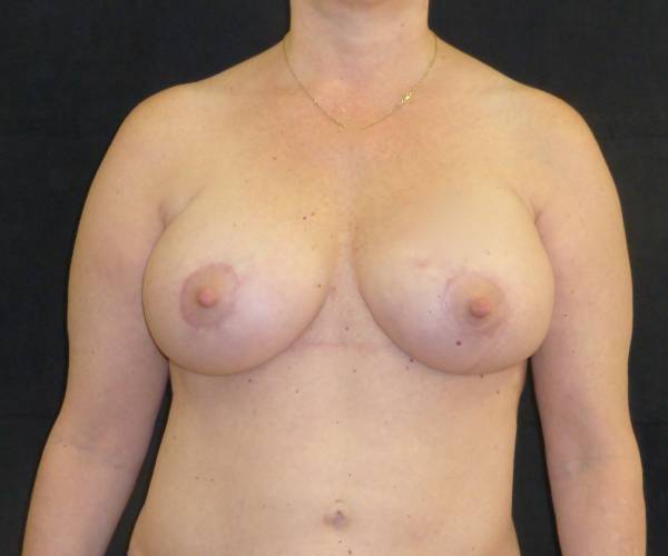 after breast augmentation with lift front view female patient case 3886