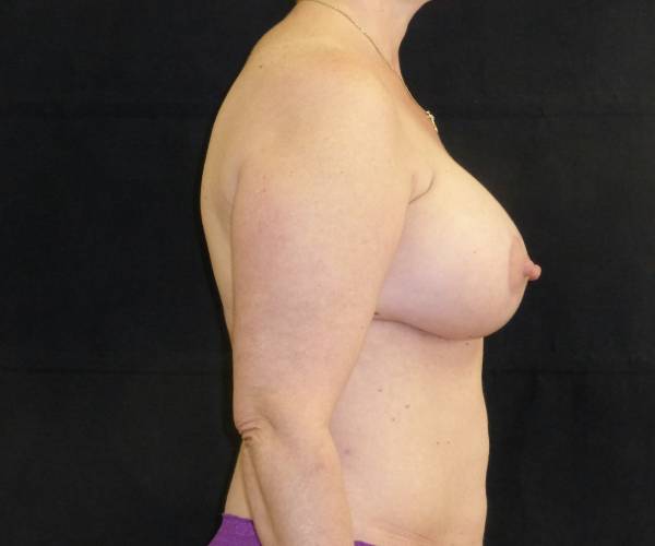 after breast augmentation with lift right view female patient case 3886