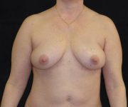 before breast augmentation with lift front view female patient case 3886