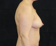before breast augmentation with lift right view female patient case 3886
