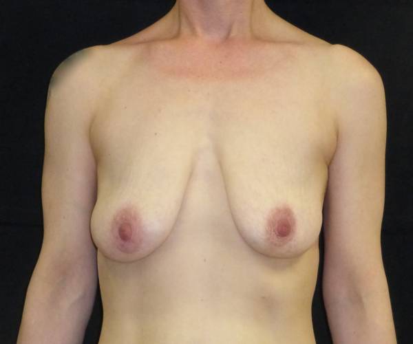 before breast lift front view female patient case 3565