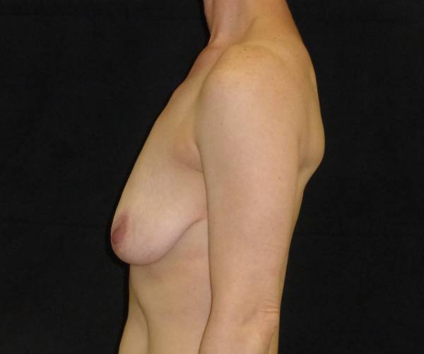 before breast lift left view female patient case 3565