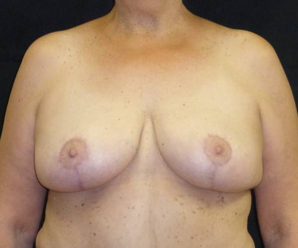 after breast lift front view female patient case 3570