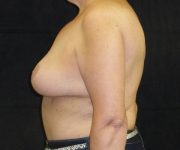 after breast lift left view female patient case 3570