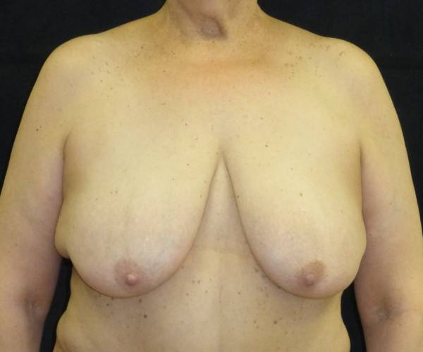 before breast lift front view female patient case 3570