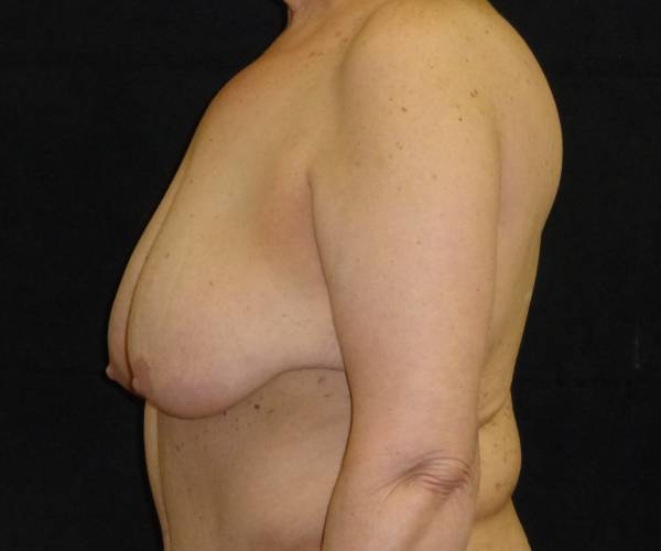 before breast lift left view female patient case 3570