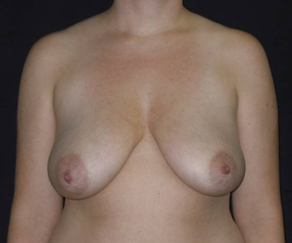 before breast lift front view female patient case 3580