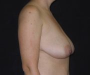 before breast lift right view female patient case 3580
