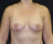after breast lift front view female patient case 3590