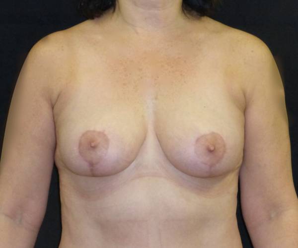 after breast lift front view female patient case 3590