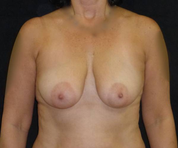 before breast lift front view female patient case 3590