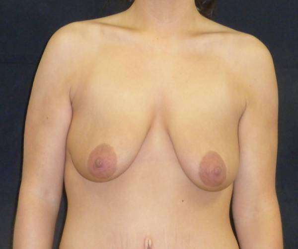 before breast lift front view female patient case 3595