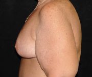 after breast reduction left view female patient case 3896