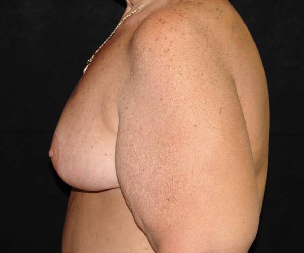 after breast reduction left view female patient case 3896