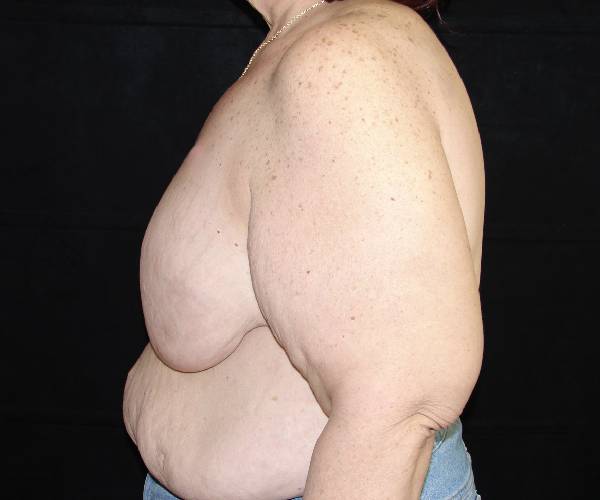 before breast reduction left view female patient case 3896