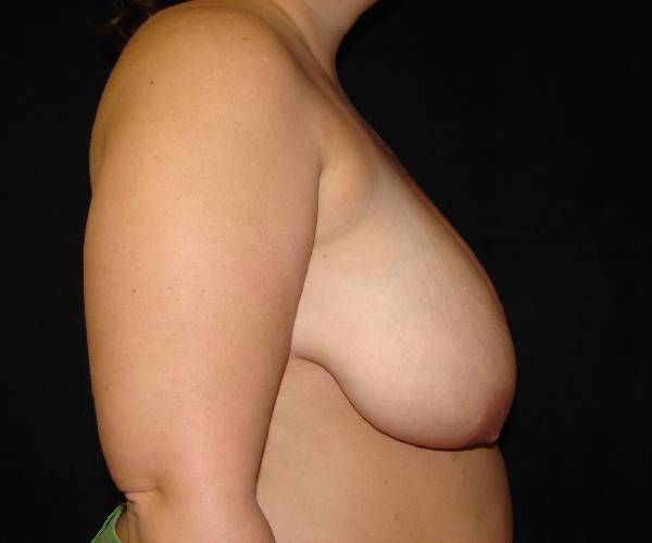 before breast reduction right view female patient case 3901
