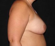 before breast reduction right view female patient case 3901