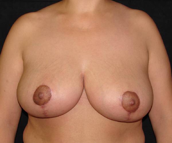 after breast reduction front view female patient case 3906