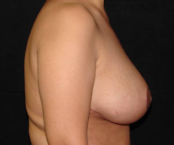 after breast reduction right view female patient case 3906
