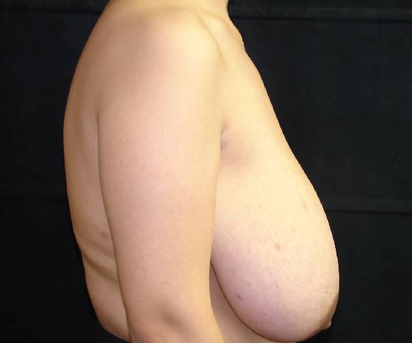 before breast reduction right view female patient case 3906