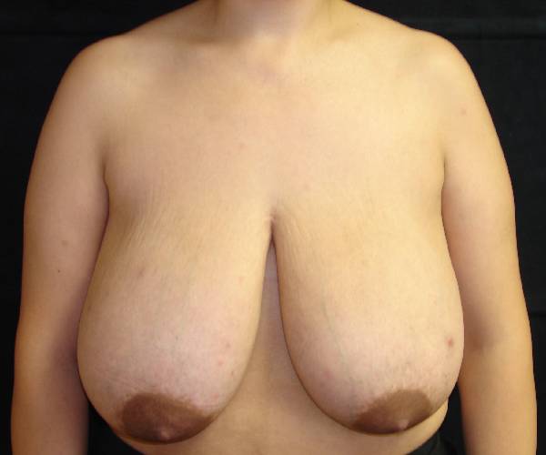 before breast reduction front view female patient case 3906