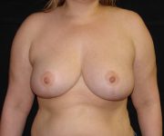 after breast reduction front view female patient case 3911