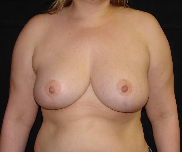 after breast reduction front view female patient case 3911