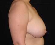 before breast reduction right view female patient case 3911