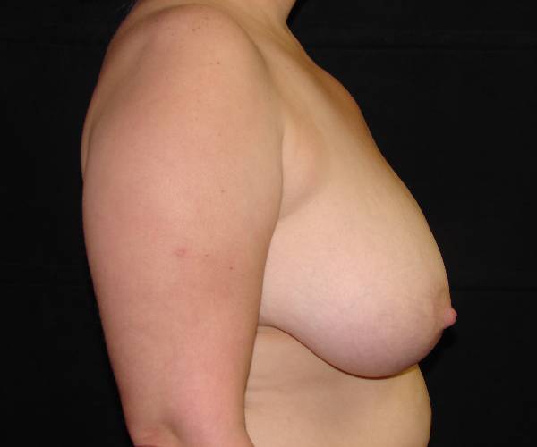 before breast reduction right view female patient case 3911