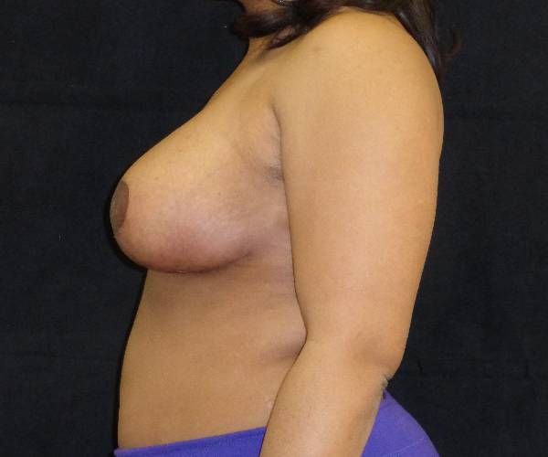 after breast reduction left view female patient case 3921