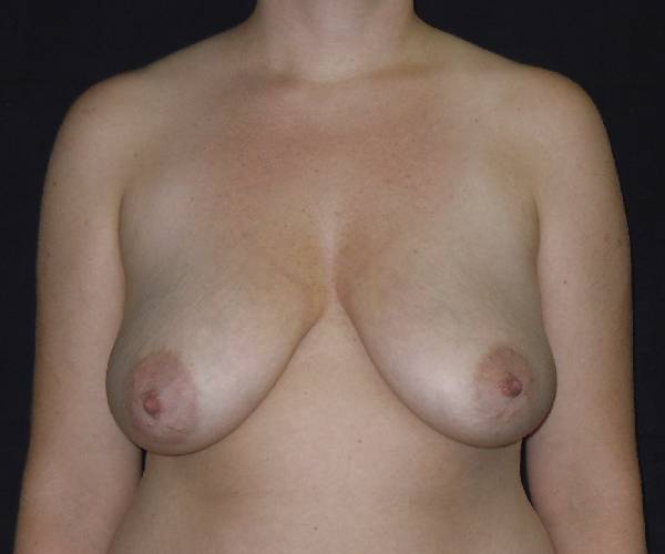 before breast reduction front view female patient case 3926
