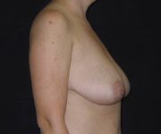 before breast reduction right view female patient case 3926