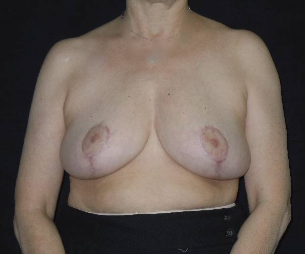 after breast reduction front view female patient case 3931