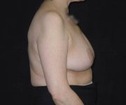 after breast reduction right view female patient case 3931