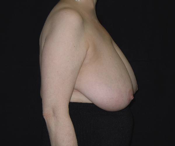 before breast reduction right view female patient case 3931