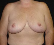after breast reduction front view female patient case 3941
