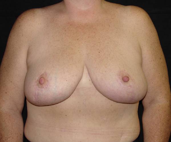 after breast reduction front view female patient case 3941